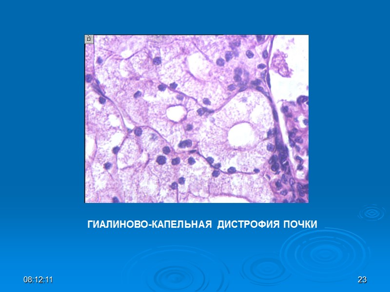 ГИАЛИНОВО-КАПЕЛЬНАЯ ДИСТРОФИЯ ПОЧКИ 08:12:01 23